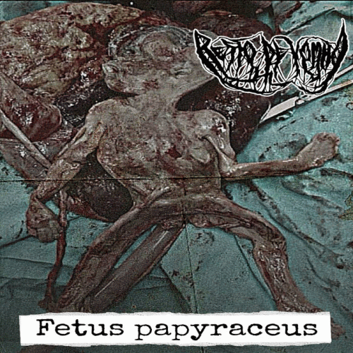 Resto De Vomito : Fetus Papyraceus